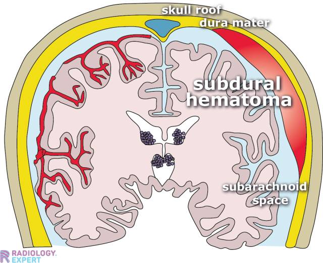 case study of brain hemorrhage